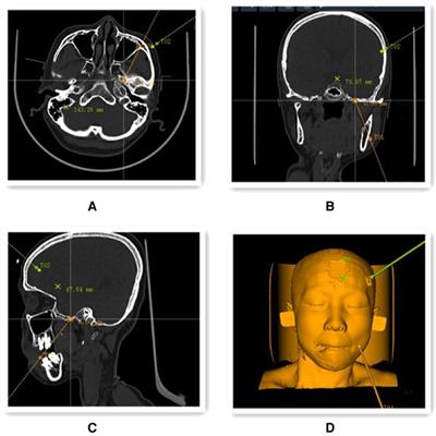 Frontiers Clinical Study On The Treatment Of Primary Trigeminal